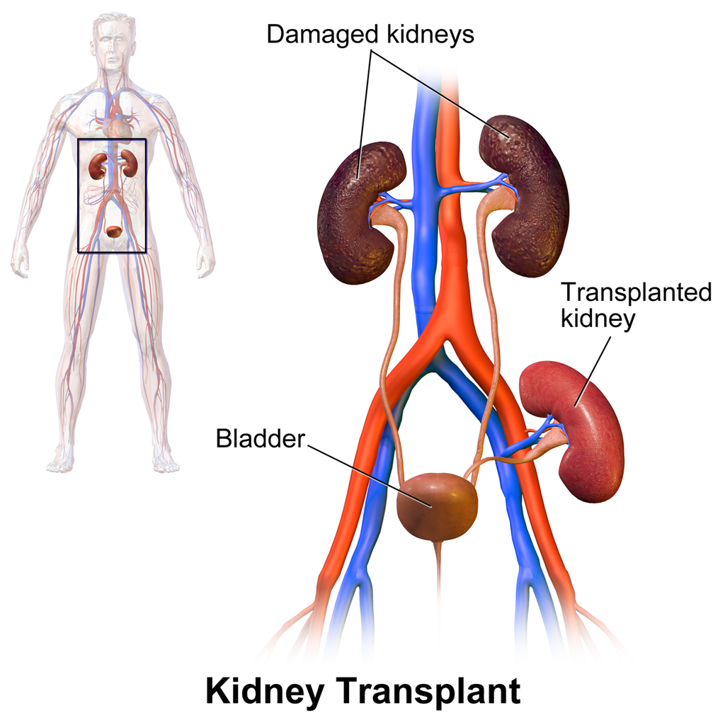 Kidney_Transplant